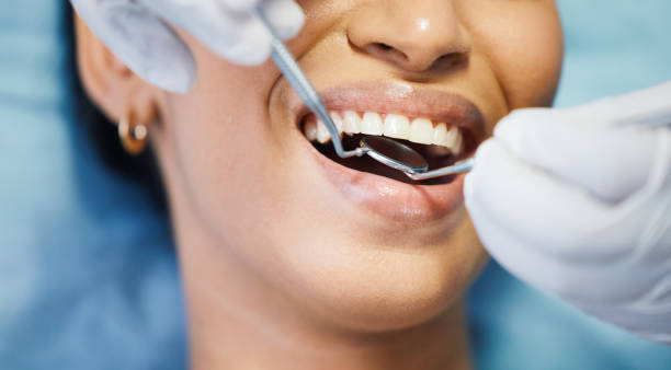 Best Emergency Wisdom Teeth Removal in Meron Park, CA
